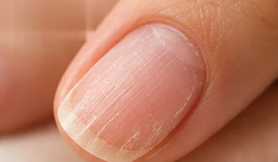 Uñas antes del tratamiento (imagen referencial)